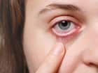Dry eyes
