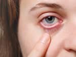 Dry eyes