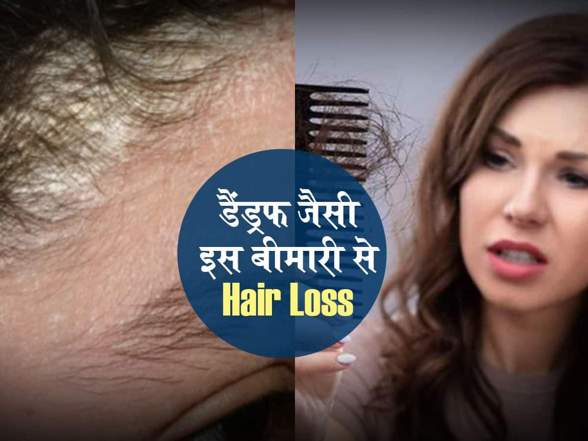 Hair Fall का कारण बन सकती है Dandruff जैसी दिखने वाली यह बीमारी, ऐसे कर  सकते हैं पहचान  हिंदी