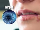 हर्पीस (Herpes)