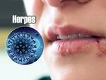 हर्पीस (Herpes)