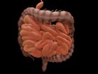 आंत का कैंसर (Bowel Cancer)