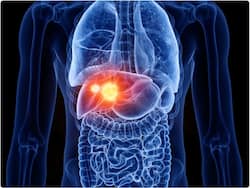 Liver Cancer In Young Healthy People: Know How To Reduce Your Risk