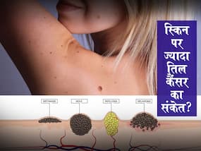 Melanoma mole: स्किन पर ज्यादा तिल होना कैंसर का हो सकता है संकेत, जानें कैसे करें जांच