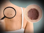 तिल (Moles)