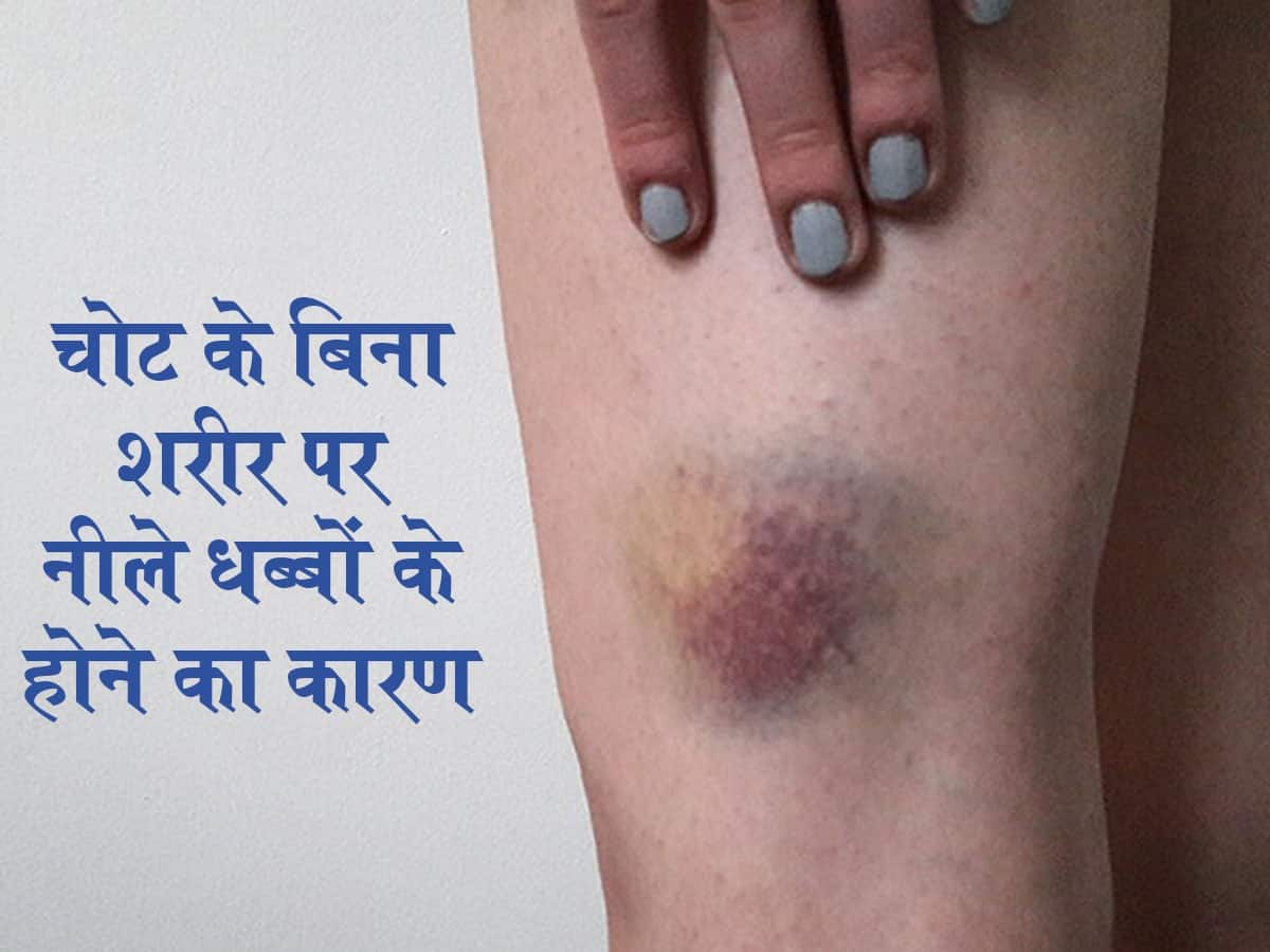 शरीर में नीले धब्बे होने का कारण और लक्षण Cyanosis Causes Symptoms in