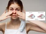 ऑप्टिक न्यूराइटिस (Optic Neuritis)