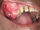 Oral cancer