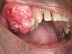 Oral cancer