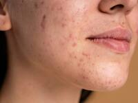 Psoriasis