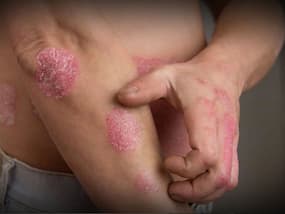 Unani Medicine for Psoriasis: यूनानी पद्धति में है सोरायसिस का पक्का इलाज, पुरानी से पुरानी Psoriasis होती है ठीक Unani Medicine for Psoriasis: यूनानी पद्धति में है सोरायसिस का पक्का इलाज, पुरानी से पुरानी Psoriasis होती है ठीक