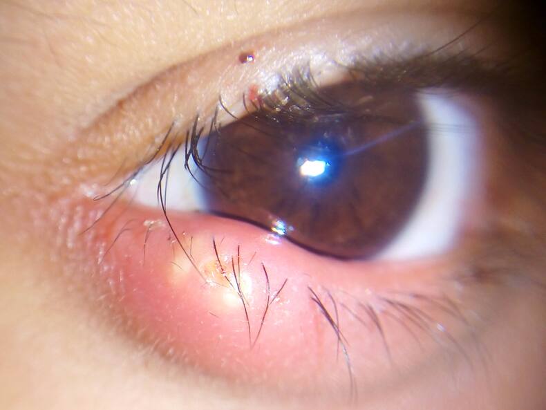 stye