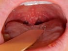 Throat cancer
