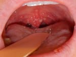 Throat cancer