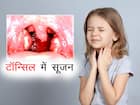 टॉन्सिल की सूजन (Tonsillitis)