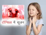 टॉन्सिल की सूजन (Tonsillitis)