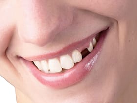 Replacing A Missing Tooth: Importance And Ways To Fix The Dental Problem