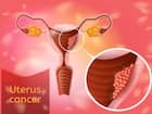 Uterine cancer