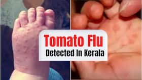Tomato Flu Confirmed In Kerala, 80 Kids Infected By The Virus: Symptoms, Causes And Other Details