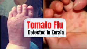 Tomato Flu Confirmed In Kerala, 80 Kids Infected By The Virus: Symptoms, Causes And Other Details