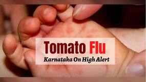 Karnataka On High Alert Over Tomato Flu Outbreak: All You Need To Know About The New Infection