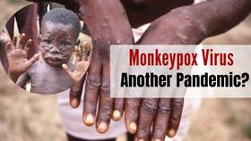 Are Indians At Risk of Monkeypox Outbreak Too? Virus Spreading Rapidly In Europe, North America
