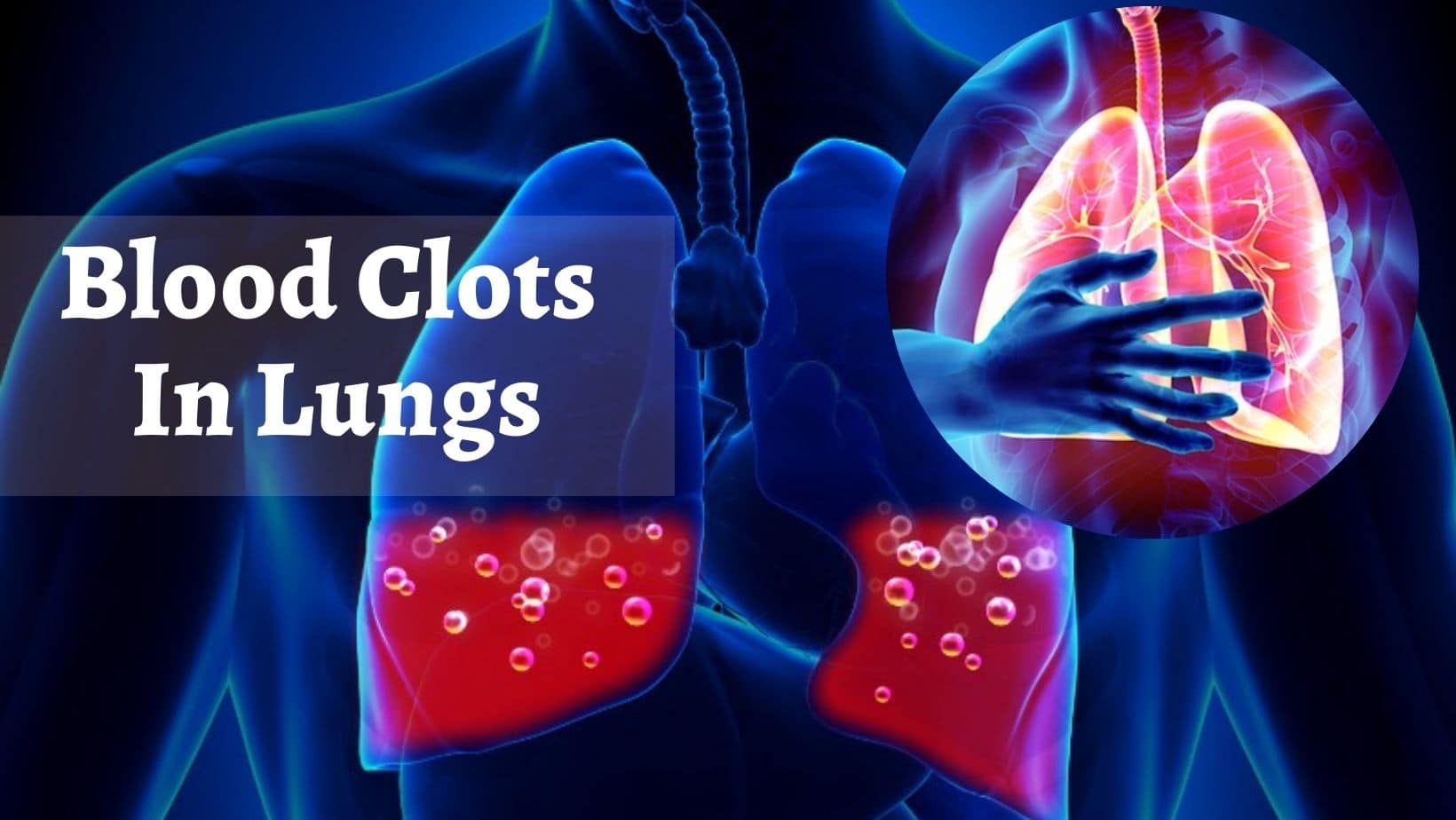 Blood Clots In Lungs Unusual PostCOVID Complication That Can Damage Your Health Completely