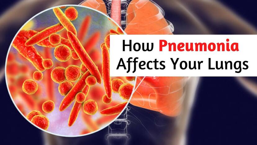 Pneumonia: How Fluid Forms Inside The Lungs And Then Damages It ...