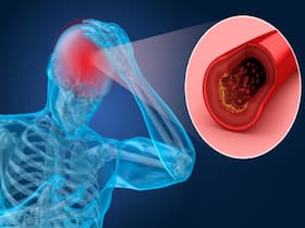 Hemorrhagic Stroke: Symptoms, Causes, Diagnosis And Treatment Hemorrhagic Stroke: Symptoms, Causes, Diagnosis And Treatment