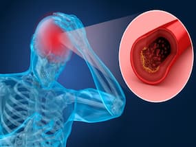 Hemorrhagic Stroke: Symptoms, Causes, Diagnosis And Treatment Hemorrhagic Stroke: Symptoms, Causes, Diagnosis And Treatment