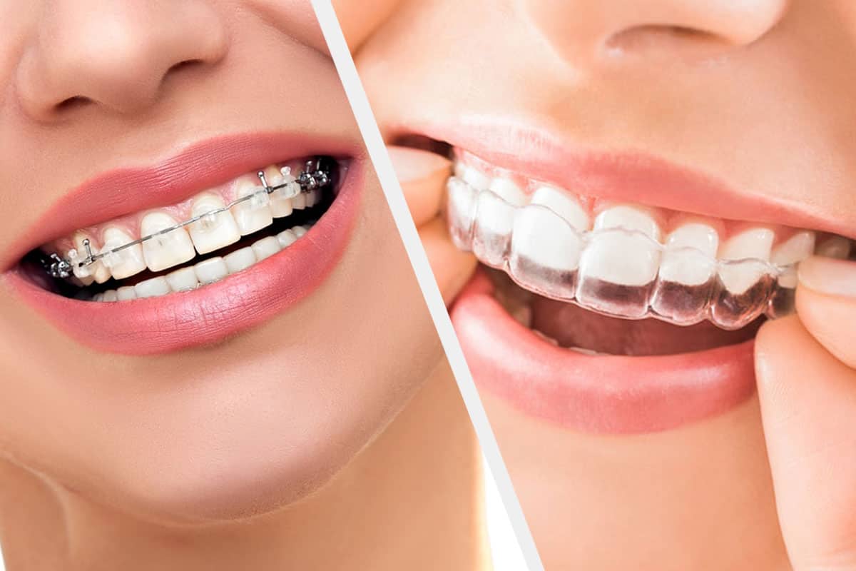 Scared of Using Metal Braces? Switch To Clear Aligners For Teeth  Straightening