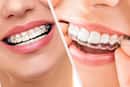 Invisalign Vs Traditional Braces: Highlighting 10 Advantages Of Invisalign For Straightening Teeth