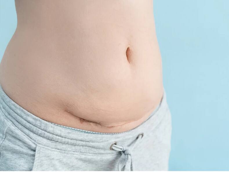 4 Yoga Exercises To Reduce Belly Fat After C-Section | TheHealthSite ...
