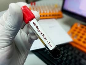 Monkeypox Outbreak: UP Issues SOPs For Health Officials, Rajasthan Starts Screening For International Travelers