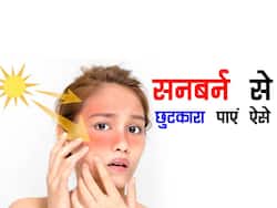 गर्मियों की धूप झुलसा सकती है आपकी त्वचा, सनबर्न की समस्या से राहत पाने के लिए ट्राई करें ये उपाय