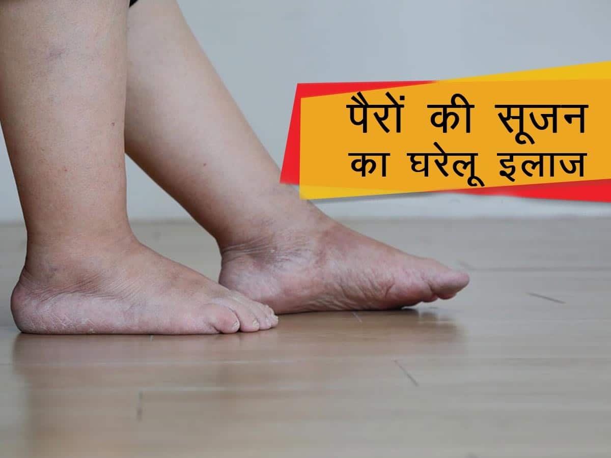 Swelling in Legs Home Remedies For Swollen Legs In Hindi पैरों की