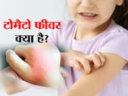 केरल में टोमैटो फीवर के मामलों ने बढ़ायी चिंता, पड़ोसी राज्य कर्नाटक और तमिलनाडु अलर्ट पर