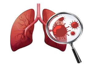 Post-COVID Lung Fibrosis Can Be Treated With This Novel Cell-Based Therapy: Expert