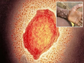 Monkeypox Can Stay Upto 10 Weeks Inside Your Body: Experts Warn of Symptoms