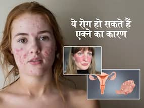 Acne Causes: इन खतरनाक बीमारियों का संकेत हो सकते हैं मुंहासे, Dermatologist को दिखाने से पहले इस बारे में जरूर जान लें
