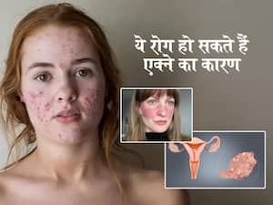 Skin Problems: इन खतरनाक बीमारियों का संकेत हो सकते हैं मुंहासे, Dermatologist को दिखाने से पहले इस बारे में जरूर जान लें