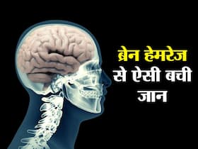 डॉक्टरों ने नई पीढ़ी का फ्लो डायवर्टर स्टेंट लगाकर बचाई 48 साल की महिला की जान, ब्रेन हेमरेज का खतरा टला