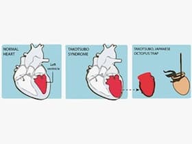 Older Women More Susceptible To Takotsubo Cardiomyopathy: Symptoms, Causes, Treatment Older Women More Susceptible To Takotsubo Cardiomyopathy: Symptoms, Causes, Treatment