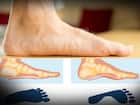 फ्लैट फुट (Flat Foot)