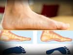 फ्लैट फुट (Flat Foot)