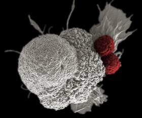 'MUSIC' Cancer Treatment Promotes Systemic Anti-tumor Immunity: Study