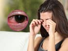 केराइटिस (Keratitis)