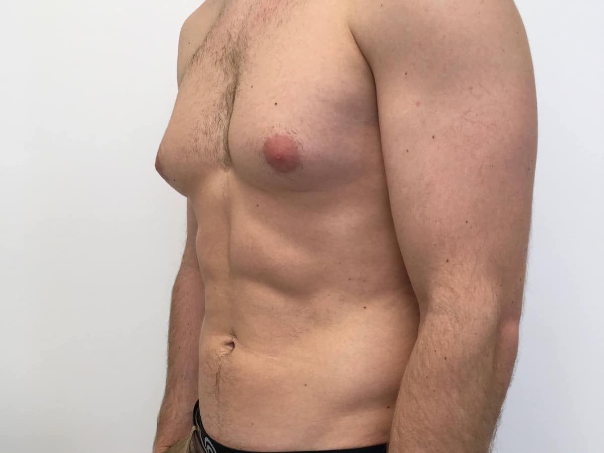 опухшая левая грудь у мужчин (120) фото