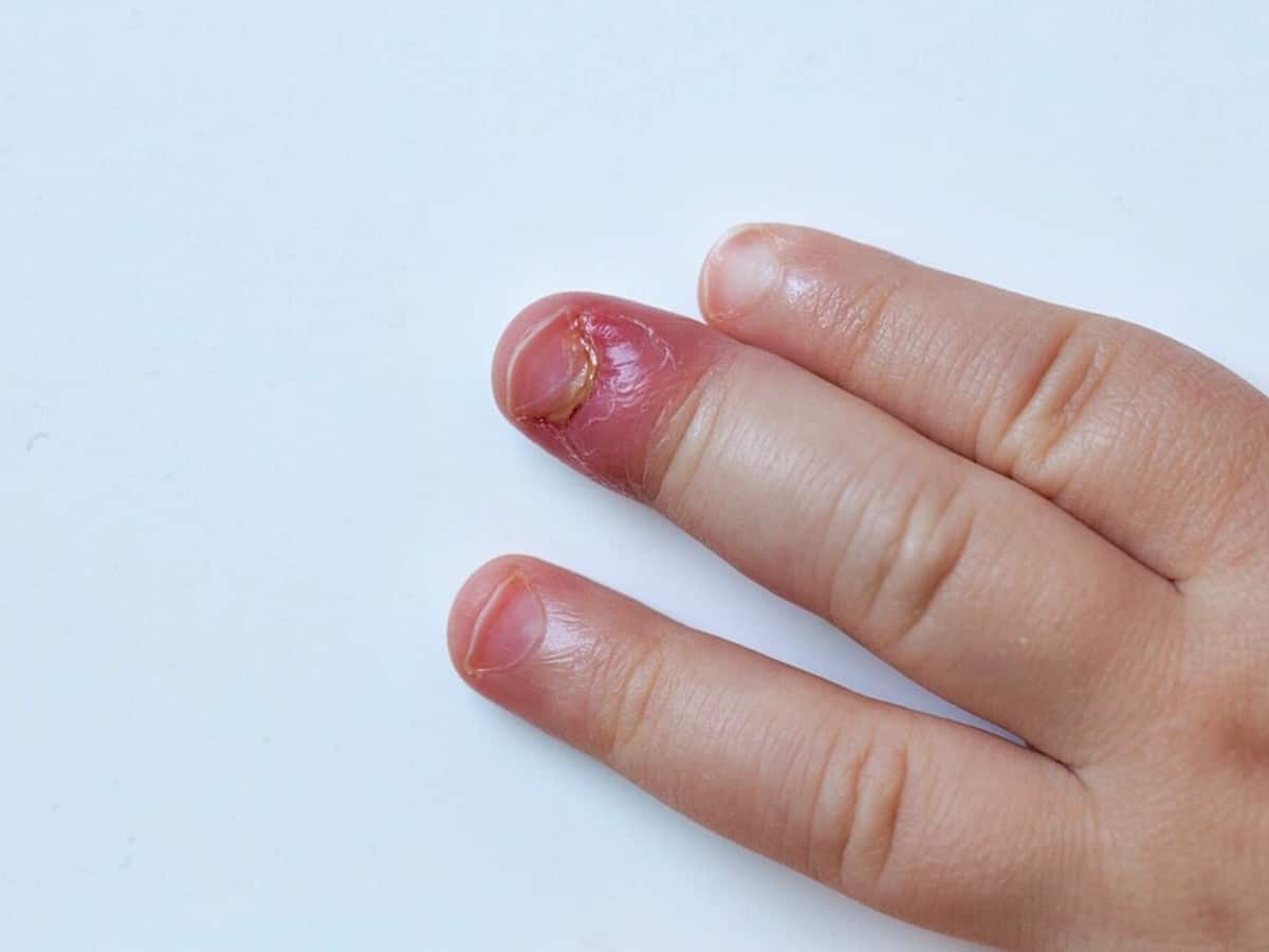 Why am I always biting the skin around my nails? I even bleed sometimes  because of it, but I do it without noticing. - Quora