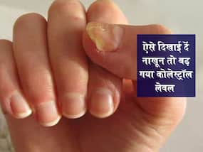 नाखून देखकर चल जाएगा पता कोलेस्ट्रॉल लेवल हो गया है हाई! इन 2 तरीकों से पता लगाएं हाई कोलेस्ट्रॉल लेवल